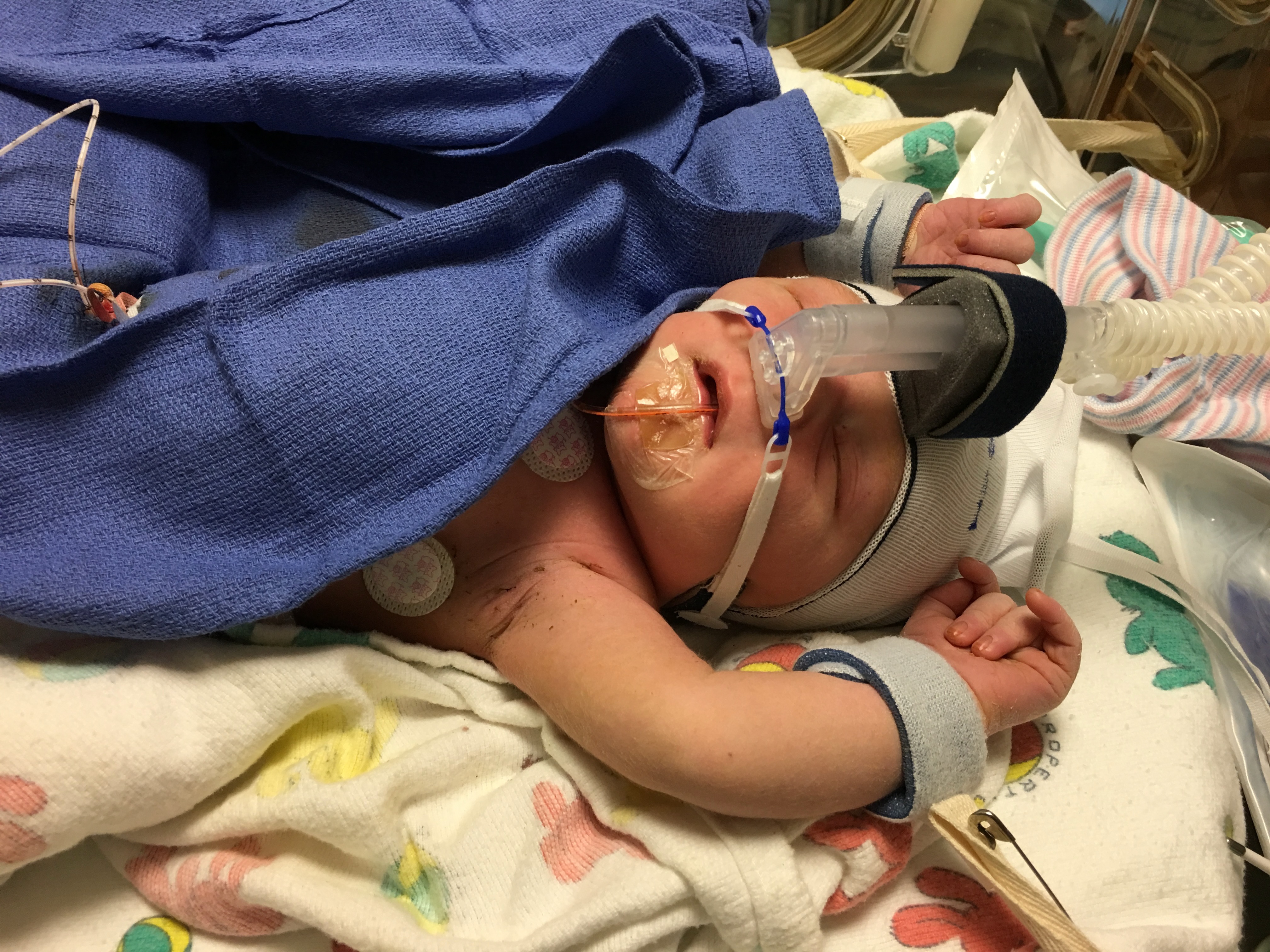 Newborn Elijah in the NICU with a CPAP mask and monitoring tubes, shortly after birth